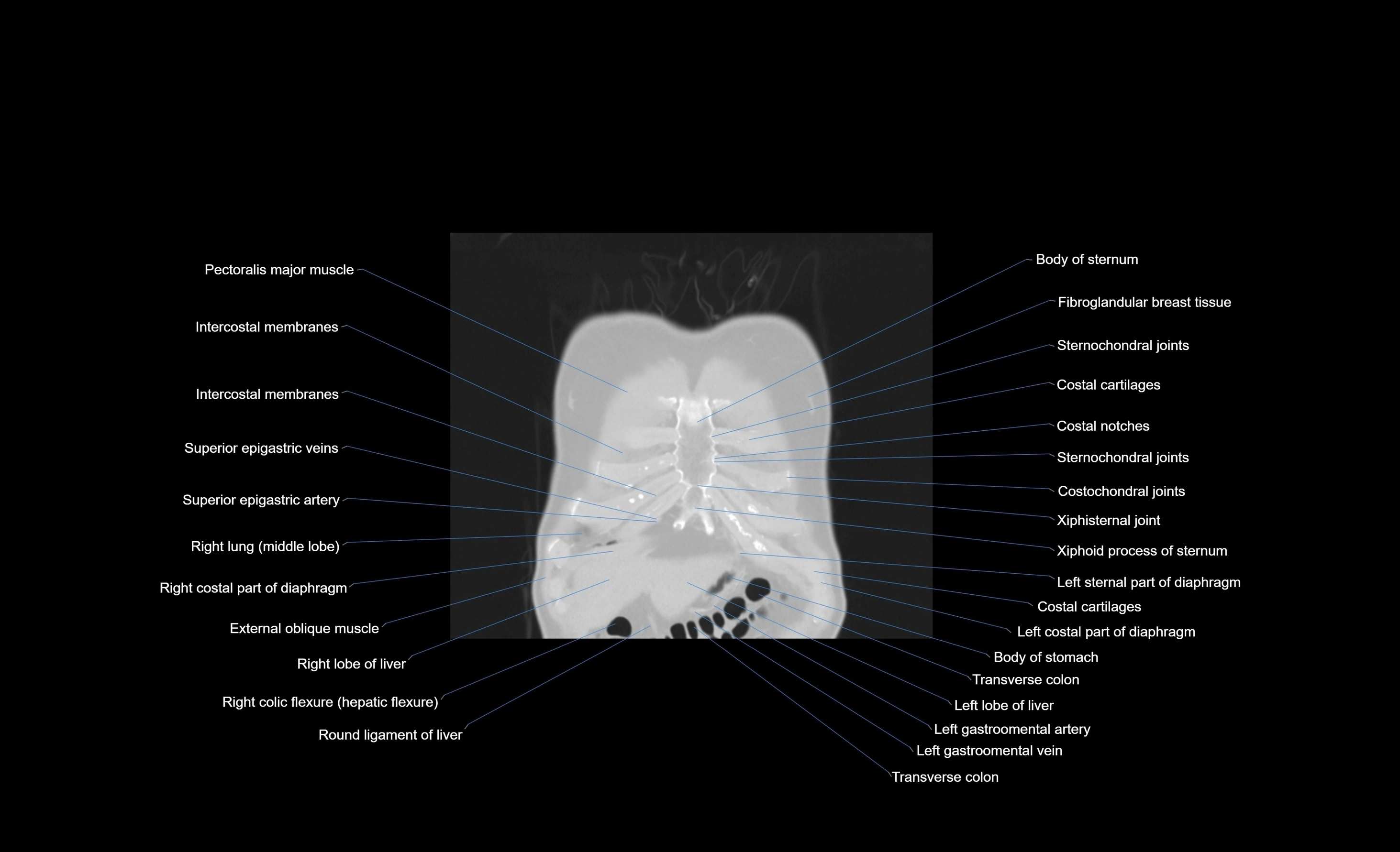 CT chest (thorax) lung window window labelled coronal cross sectional anatomy radiology image-00102.webp